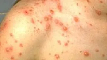 O fata de 11 ani bolnava de varicela a murit, dupa ce bunica ei a dat-o cu o solutie toxica crezand ca are raie