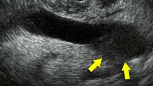 Verdict cutremurator: Un sportiv urias are CANCER si va fi operat de urgenta! Anuntul care a speriat o lume intreaga