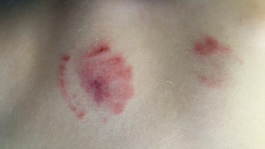 Un copil a venit de la grădiniţă cu MUŞCĂTURI pe tot corpul. Explicaţia HALUCINANTĂ a directoarei pentru părinţi: "Înţeleg îngrijorarea dumneavoastră, dar, în acelaşi timp..."