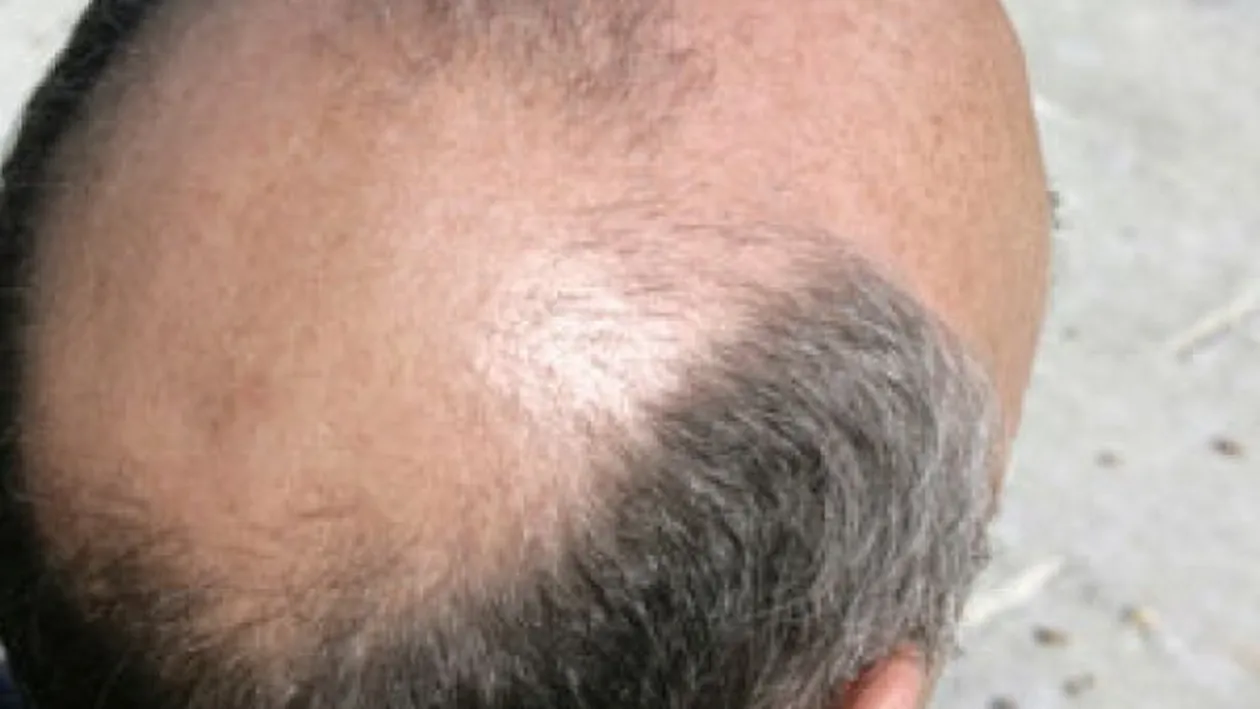 Un actor celebru din Romania si-a facut implant de par: Am fost anesteziat total timp de 7 ore Imaginile pe care vrea sa le uite