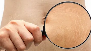 Ce sunt vergeturile, de ce apar și cum le putem trata