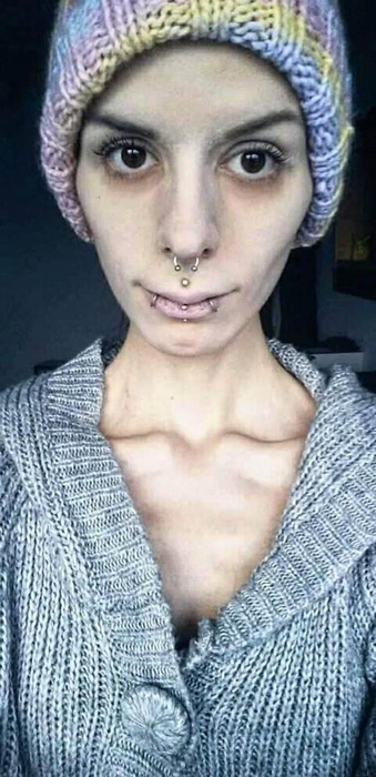 Cazul şocant al fetei care îşi ascundea mâncarea în urechi! Julia cântărea 32 de kilograme, dar a învins anorexia. Cum a reuşit!