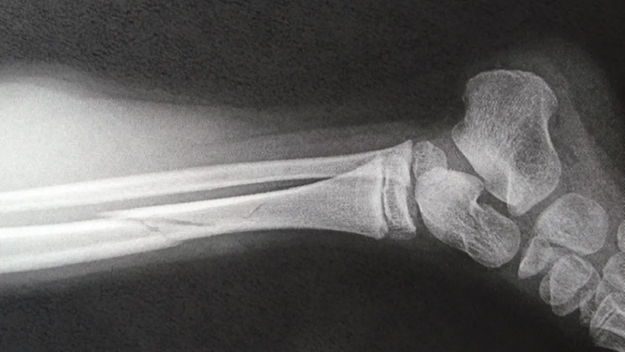 Neglijenţa cadrelor medicale poate fi fatală!O fetiţă de 4 ani a murit în urma unei fracturi la picior!