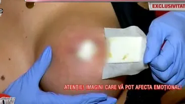 Drama Mădălinei-Beyonce de România, după implantul cu silicon. ”Mi-a căzut mamelonul, iar sânul mi se macină pe zi ce trece”