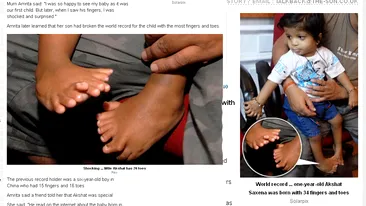 Uite cum arata copilul care are 34 de degete! Unic in lume