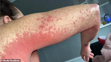 O femeie în vârstă de 41 de ani, reacție ciudată după imunizarea cu AstraZeneca