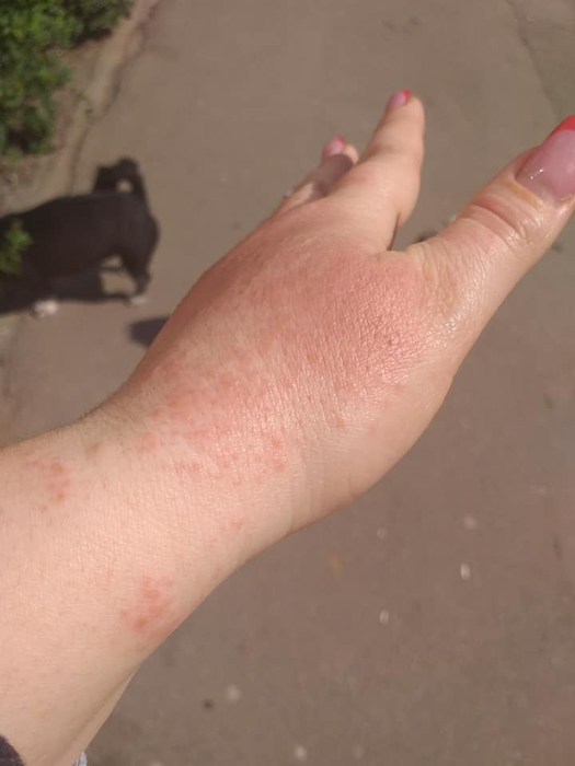 Imagini ireale! Ce a pățit o femeie după ce s-a spălat cu dezinfectant într-un supermarket din Brăila