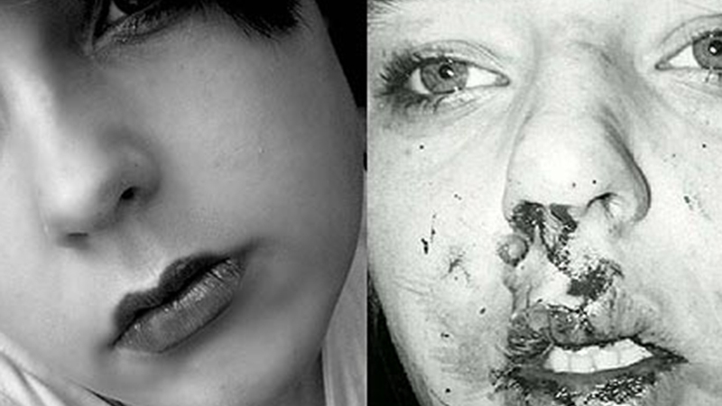 Povestea incredibilă a unei tinere autiste desfigurate de o gaşcă de bătăuşi! Le-a râs în nas şi a devenit model!