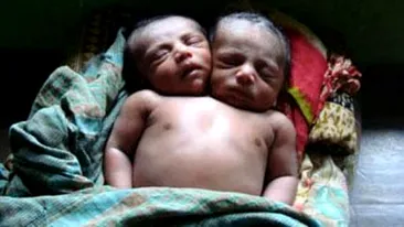 Caz uluitor, in India! O femeie a nascut un copil cu doua capete! Uite imaginile cu bebelusul!
