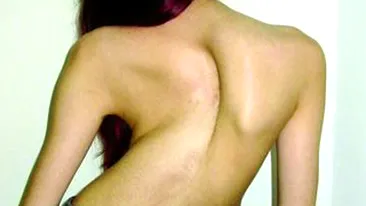 Medicii de la Grigore Alexandrescu au operat cel mai grav caz de scolioza din lume! Pacienta are 16 ani!