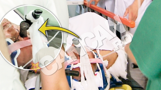 Un hunedorean a fost la un pas de moarte in timp ce toaleta copacii. La spital, cu foarfeca infipta in cap