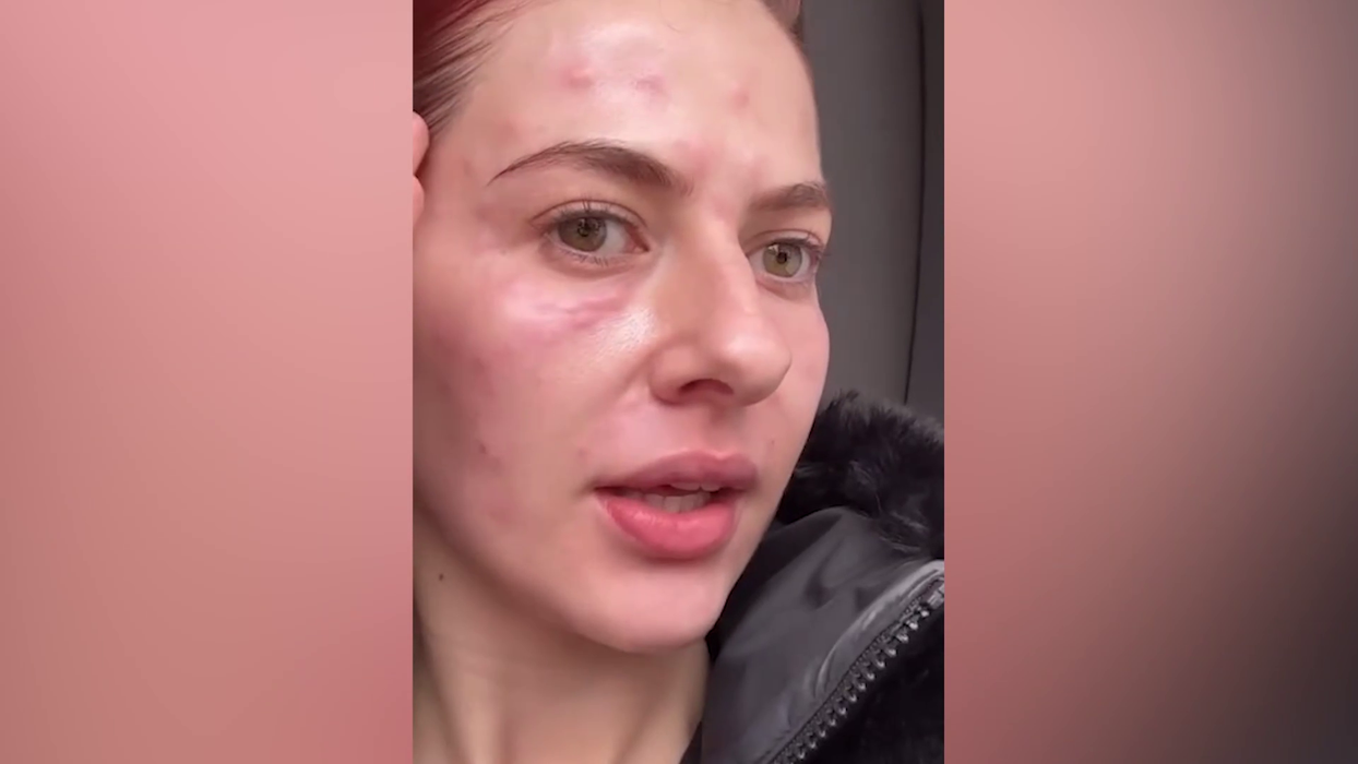 Lidia Buble și-a speriat fanii! A apărut cu fața inflamată și amorțită: „Nu arată rău. Acum e cel mai umflat”