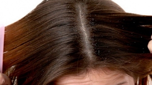 Scapă de mătreaţă cu soluţii naturale şi la îndemâna oricui! Remediile care nu dau greş!