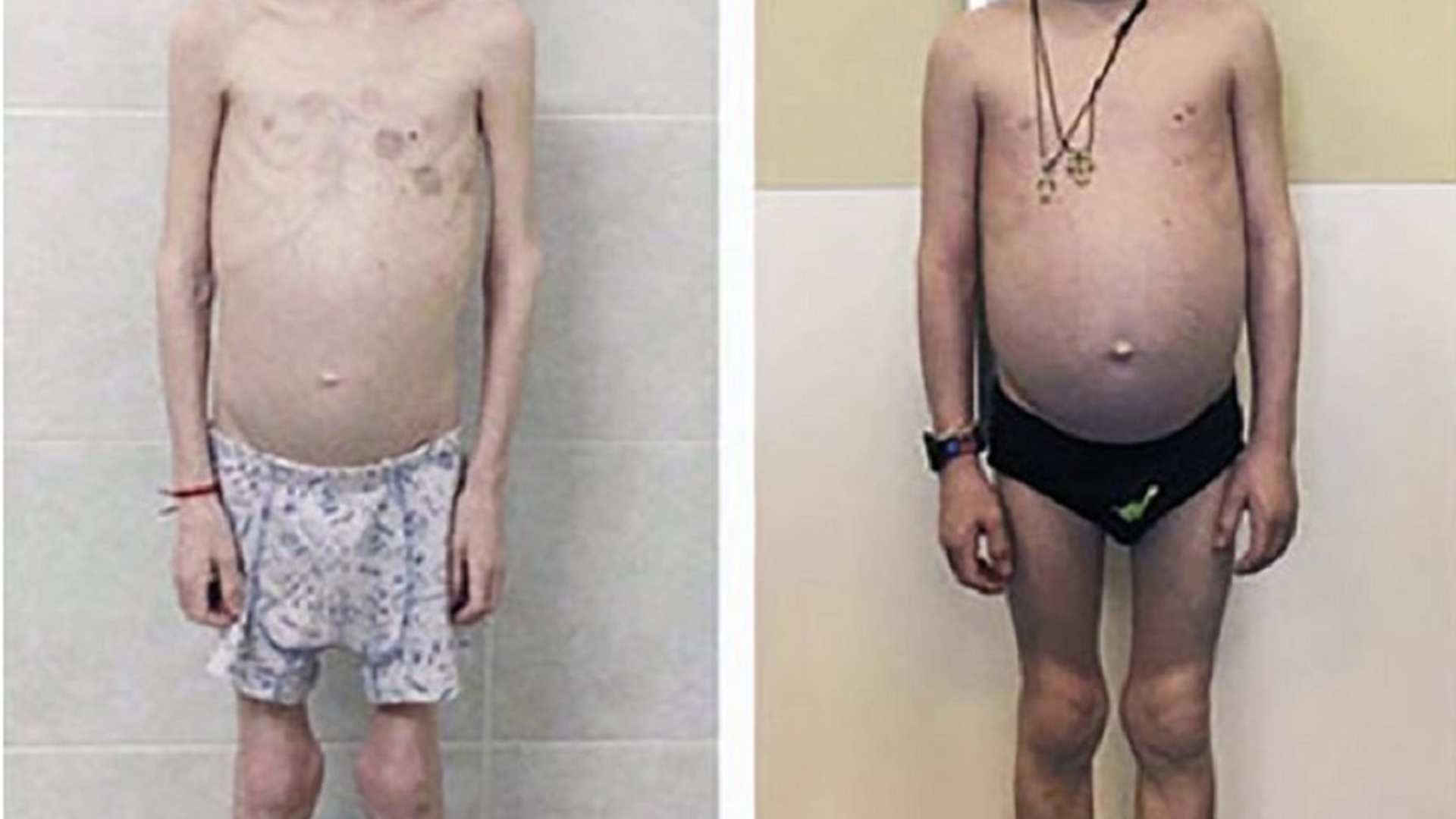 La 11 ani, e piele şi os şi are înălţimea unui copil de cinci ani. Motivul pentru care o mamă şi-a înfometat fiul şi l-a drogat
