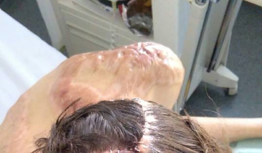 FOTO / Imagini şocante cu unul dintre supravieţuitorii din #Colectiv, dar şi mărturii sfâşietoare despre viaţa mutilată de incendiu: „Tifonul se desface trăgând după el ţesutul necrozat sau fragmentele lizate de grefă, lăsând în urmă doar rană vie, din care şiroieşte sânge roşu, curat”