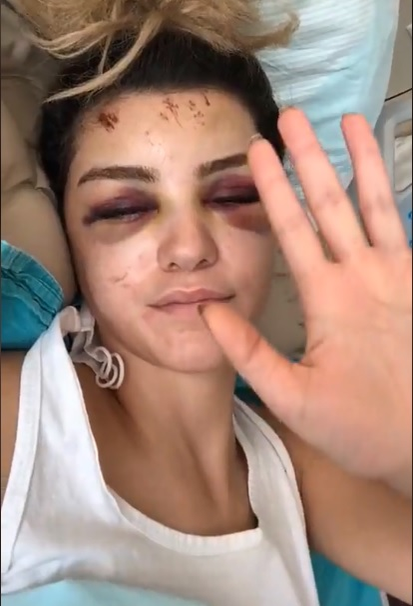 Nurella, victima unui accident bizar