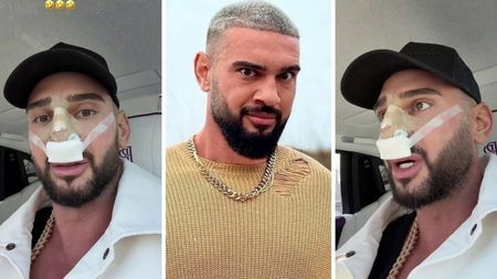 Dorian Popa, la un pas să îi „cadă nasul ca lui Michael Jackson”! Ce i-a descoperit medicul la operație? „Habar nu aveam”