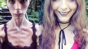 Cazul şocant al fetei care îşi ascundea mâncarea în urechi! Julia cântărea 32 de kilograme, dar a învins anorexia. Cum a reuşit!