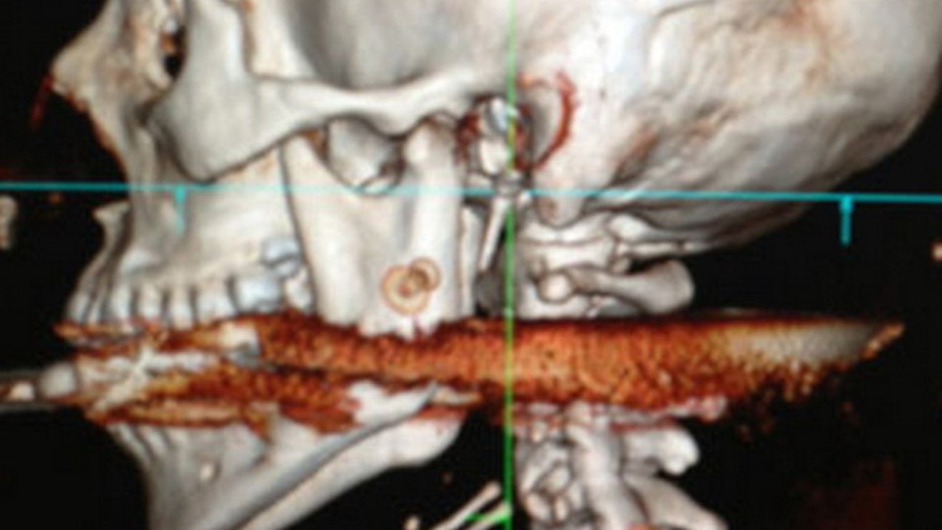 HORROR! Cum arata aceasta tanara frumoasa frumoasa dupa ce a fost "impuscata" cu un harpon in gat