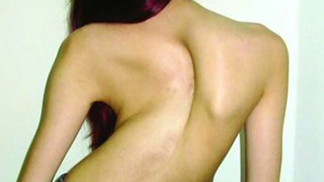 Medicii de la Grigore Alexandrescu au operat cel mai grav caz de scolioza din lume! Pacienta are 16 ani!