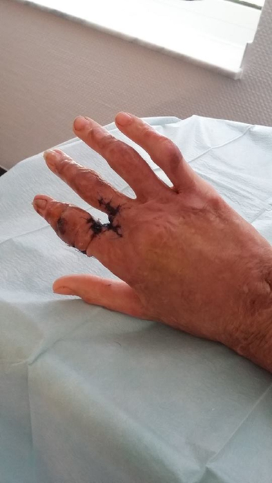 FOTO / Imagini şocante cu unul dintre supravieţuitorii din #Colectiv, dar şi mărturii sfâşietoare despre viaţa mutilată de incendiu: „Tifonul se desface trăgând după el ţesutul necrozat sau fragmentele lizate de grefă, lăsând în urmă doar rană vie, din care şiroieşte sânge roşu, curat”