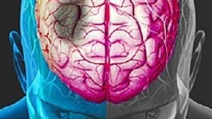 Cel mai rapid mijloc de diagnosticare a accidentului cerebral de către nespecialiști