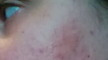 A luat medicamente ca sa scape de COSURI, dar a fost la un pas sa ORBEASCA! Ce a patit aceasta tanara