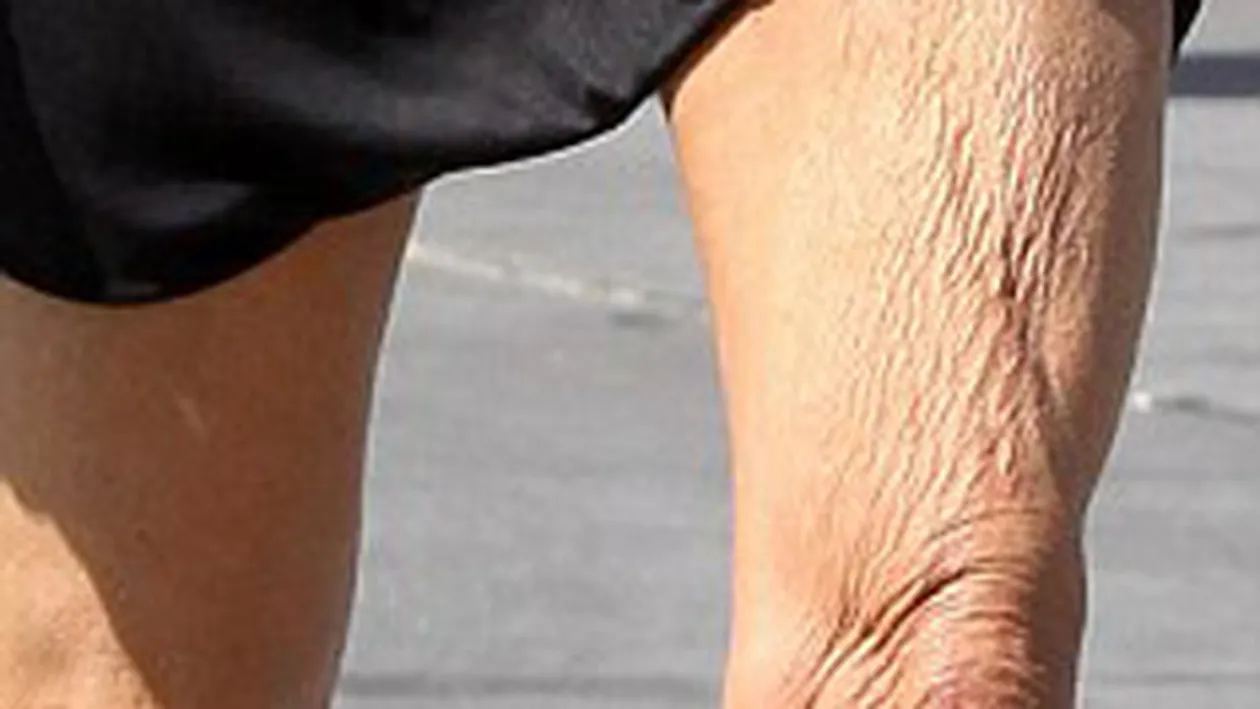 Imagini horror! Un fost model a speriat telespectatorii cu picioarele ei! Poarta rochii scurte, desi ii atarna pielea ingrozitor!