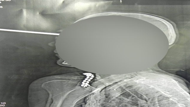 Medicii, socati cand au vazut radiografia acestui barbat. "Imposibil. Imaginile sunt de cosmar. E o minune ca inca respira"