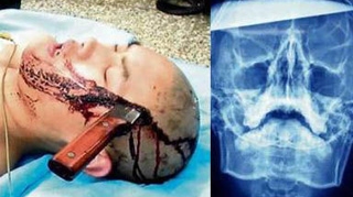 SOCANT! Un baiat de 16 ani din China a ajuns cu un cutit in cap la spital