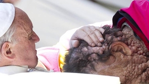 Imaginea care a făcut inconjurul lumii! Papa Francisc imbrătisează un om desfigurat, cu dureri cumplite