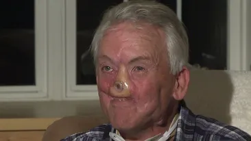 Și-a pierdut nasul într-o luptă cu un urs Grizzly, iar acum îl are atașat de braț