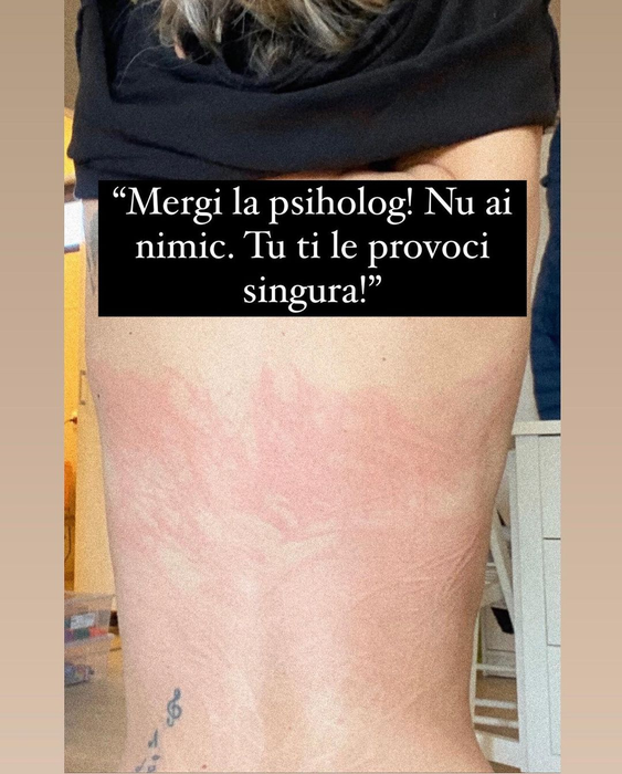 În ce stare se află Adda la câteva luni după ce a fost diagnosticată cu boala Lyme: „Urmează 18 luni de injecții, 80 la număr”