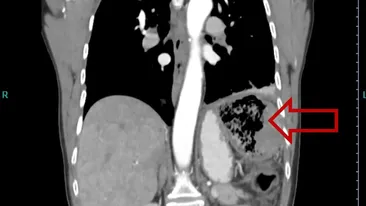 De necrezut! Ce obiect au găsit chirurgii în corpul unei femei. Fusese uitat acolo în anul 1999