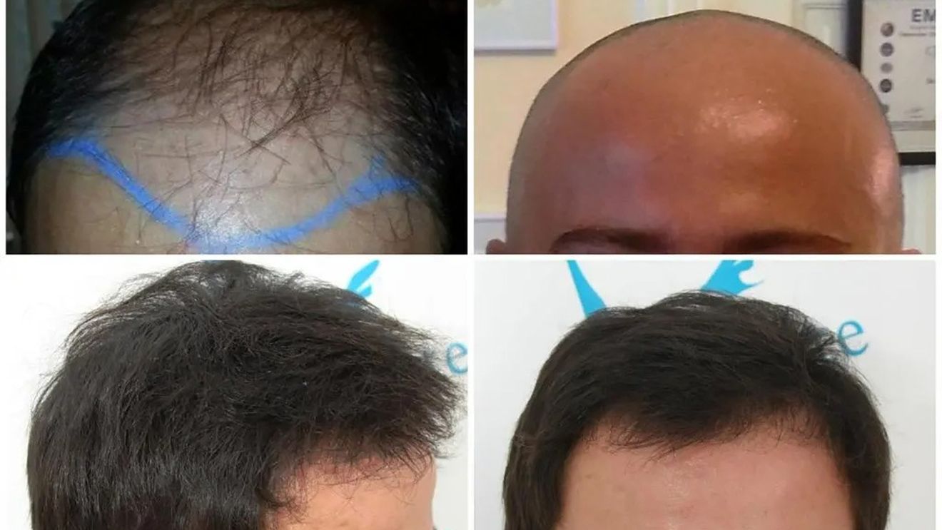 (P) Știai că implant de par Q-FUE manual avansat te ajută să arăți mai tânăr? Iată ce implică