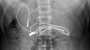 Medicii au crezut că nu văd bine! Ce gadget au putut găsi în stomacul unui adolescent care acuza dureri de burtă
