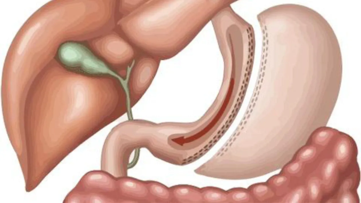 Vedete care şi-au micşorat stomacul. Viaţa li s-a schimbat total după operaţie