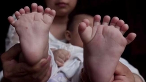 Medicii au fost şocaţi! Aşa arată băiatul care s-a născut cu 31 de degete la mâini şi la picioare