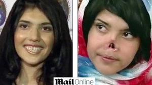 Fata care a sfidat Islamul si a fost mutilata de sotul ei are sansa unei vieti normale! Medicii i-ar refacut chipul