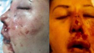 Au avut nevoie de poze ca sa ii reconstruiasca fata! Cum arata acum femeia snopita in bataie de iubitul exagerat de gelos