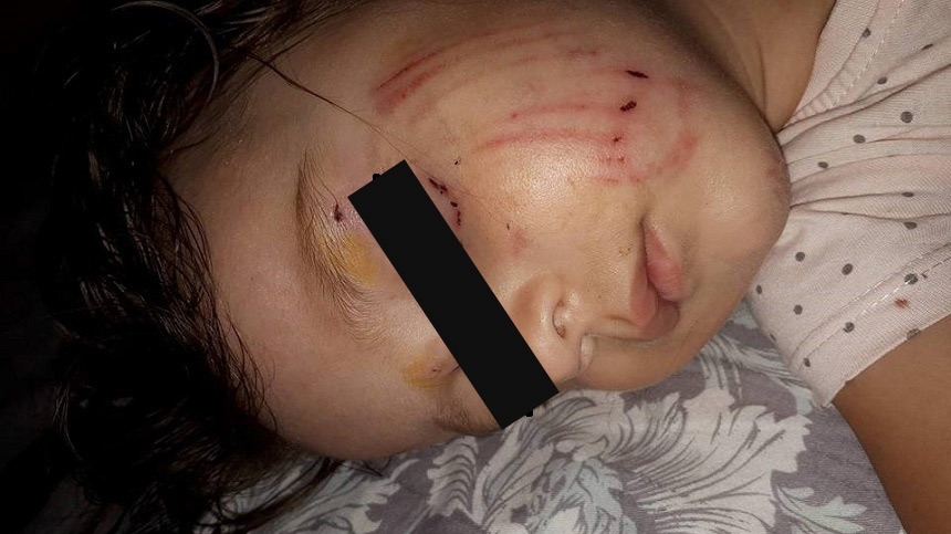 Drama unui copilaş muşcat de faţă de un câine la locul de joacă! Stăpânul animalului s-a făcut nevăzut!