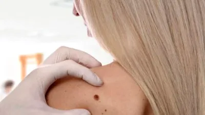 Sigur te-ai întrebat și tu: De ce apar alunițele?