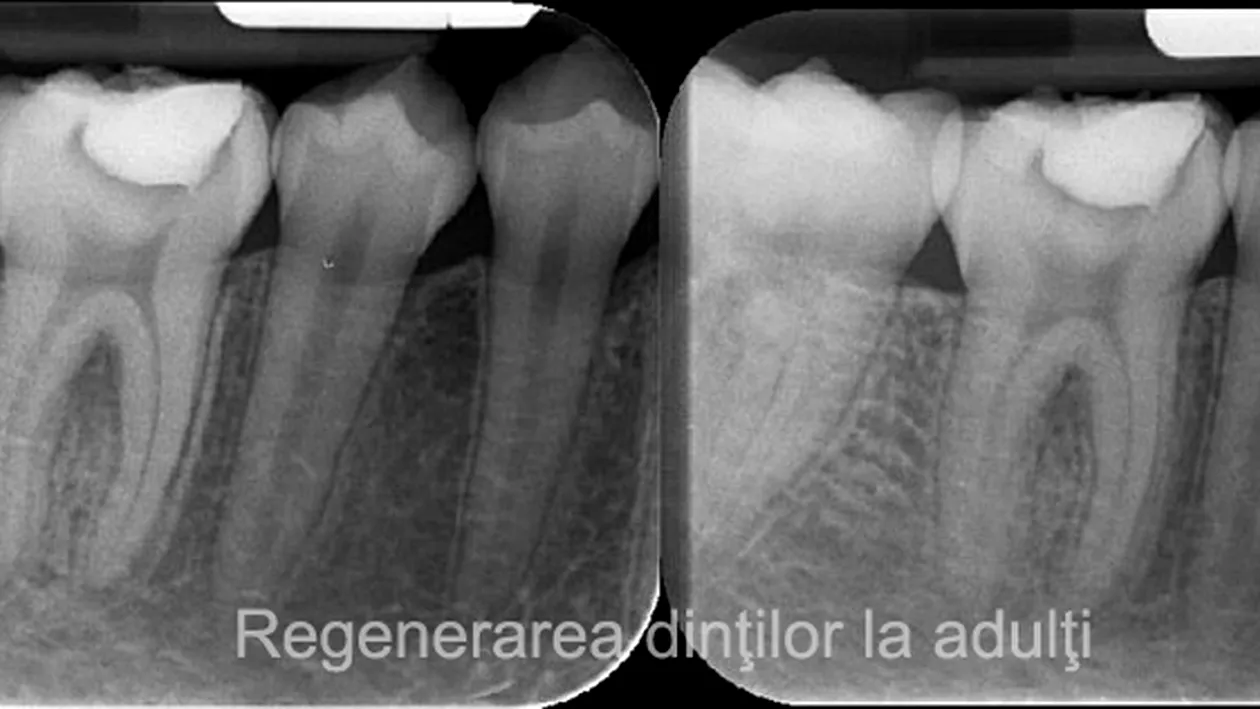 Descoperire uluitoare în medicină. Un medicamant uzual poate regenera dinții
