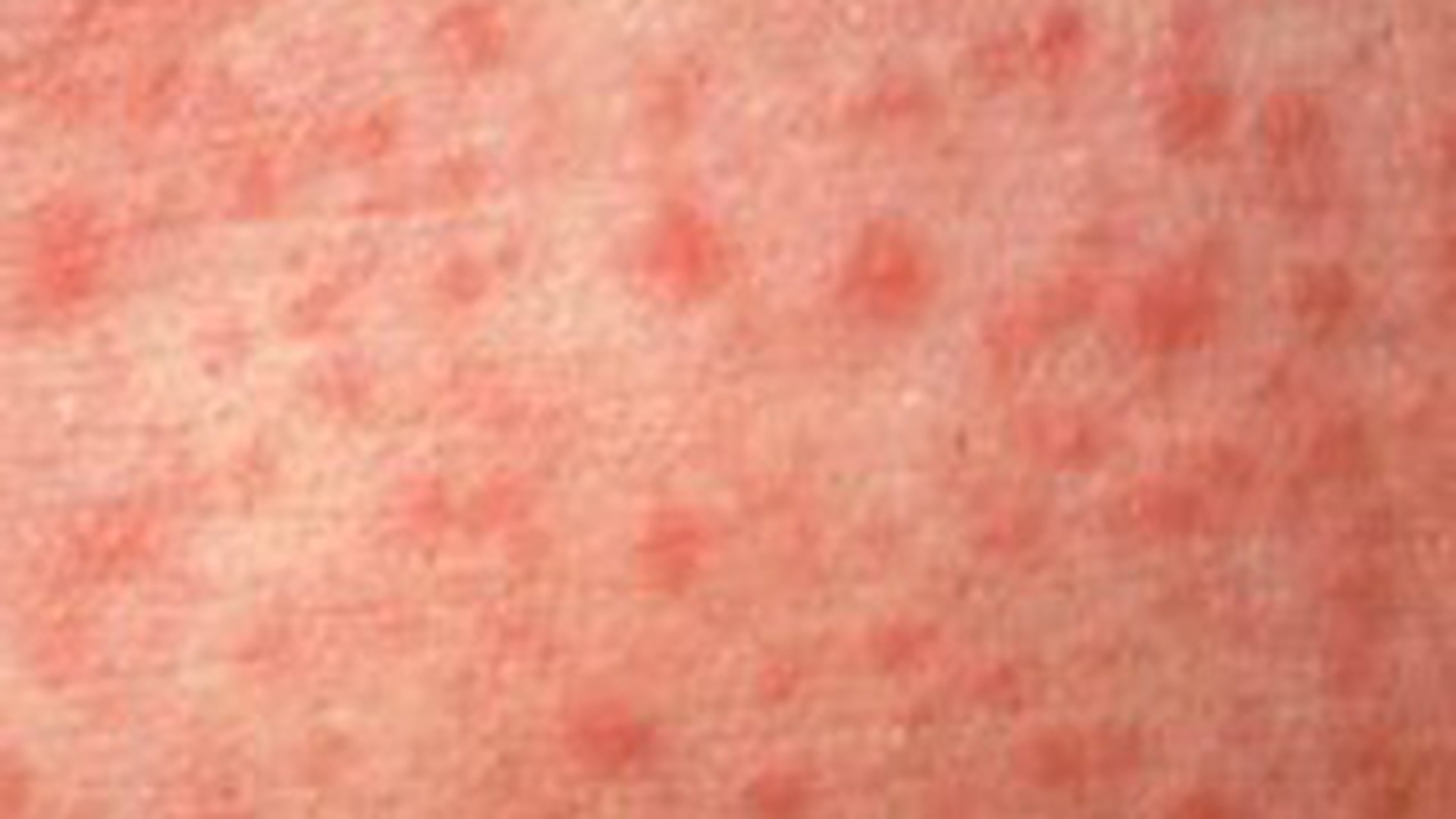O fetita de 11 ani a murit de rujeola. Alti 5 copii sunt internati cu acelasi diagnostic