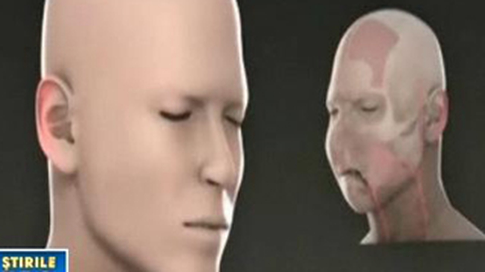VIDEO S-a realizat primul transplant facial total!