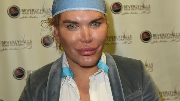 Păpuşa umană Ken şochează din nou! A cheltuit o sumă exorbitantă pentru transplant de păr şi s-a decis să....