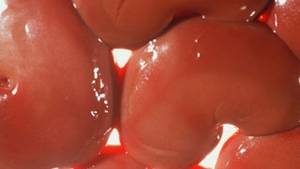 Rinichii romanilor saraci, transplantati ilegal intr-o clinica din Africa de Sud