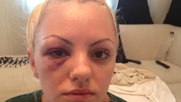 Imagini-soc! Alexandra Stan, snopita in bataie! “Accidentul a fost o inventie! Managerul meu m-a batut pana m-a bagat in spital”
