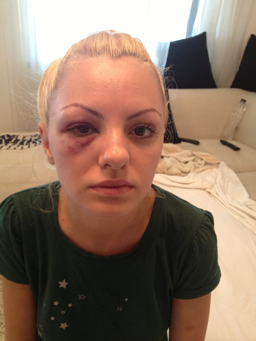Alexandra Stan, după ce a fost bătută de Marcel Prodan (Foto: CANCAN.RO)