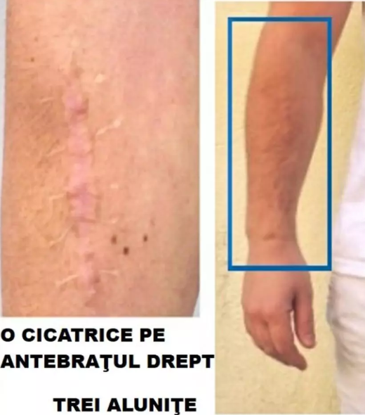 Cicatricea și cele trei alumițe grupate